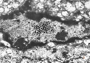 F,43y. | herpetic tracheobronchitis